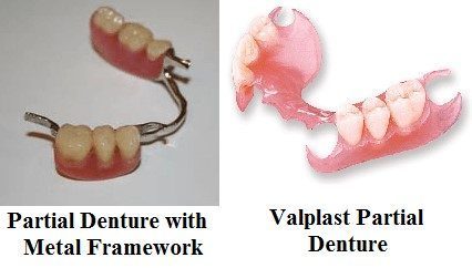 The difference in Metal vs Valplast Partial Dentures